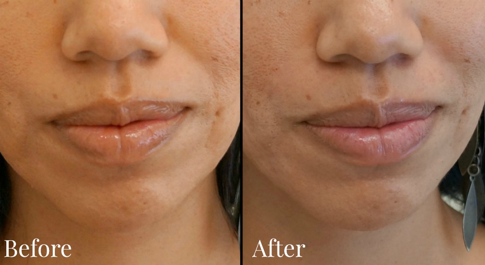 Before and after pictures with Juvederm