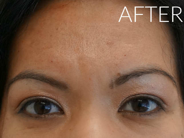 After Botox // LivingMiVidaLoca.com