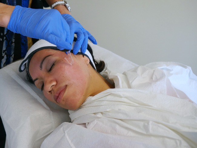 Dermapen treatment // livingmividaloca.com