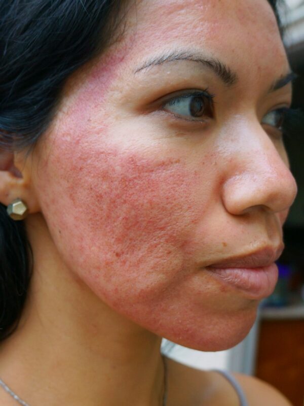 Before and after pictures of micro needling with PRP and before and