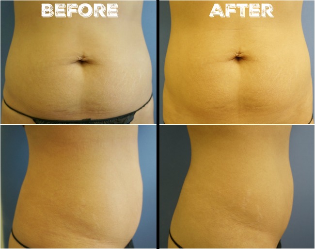 Trusculpt before and after pictures // livingmividaloca.com