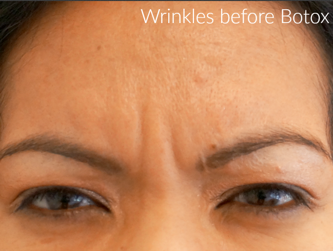 Wrinkles before Botox // LivingMiVidaLoca.com