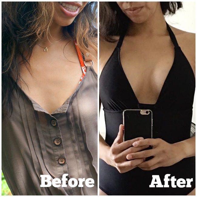 Before and after breast augmentation