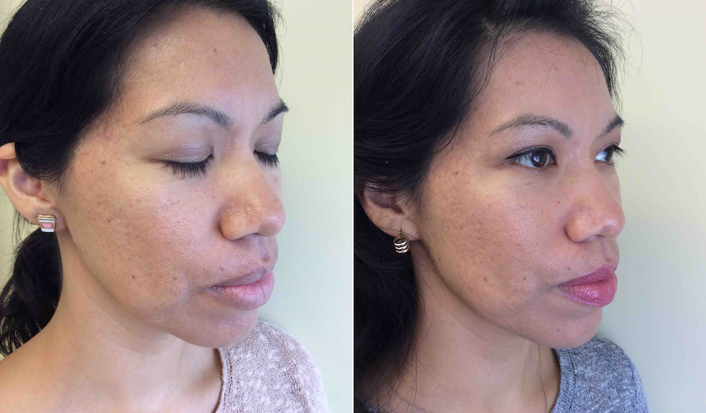 Microneedling with PRP at CosmetiCare to remove acne scars, uneven skin texture and large pores. | livingmividaloca.com | #cosmeticare #beautytreatments #spatreatments