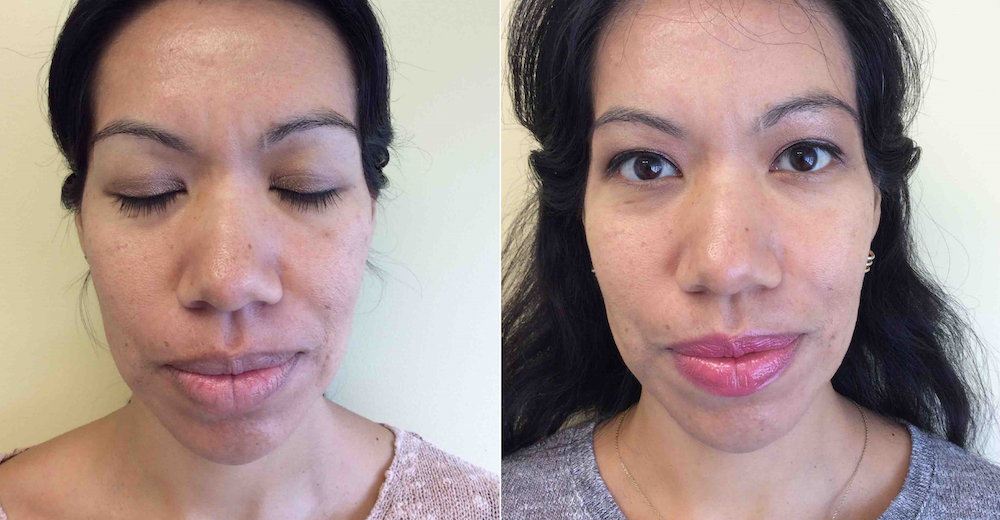 Microneedling with PRP at CosmetiCare to remove acne scars, uneven skin texture and large pores. | livingmividaloca.com | #cosmeticare #beautytreatments #spatreatments