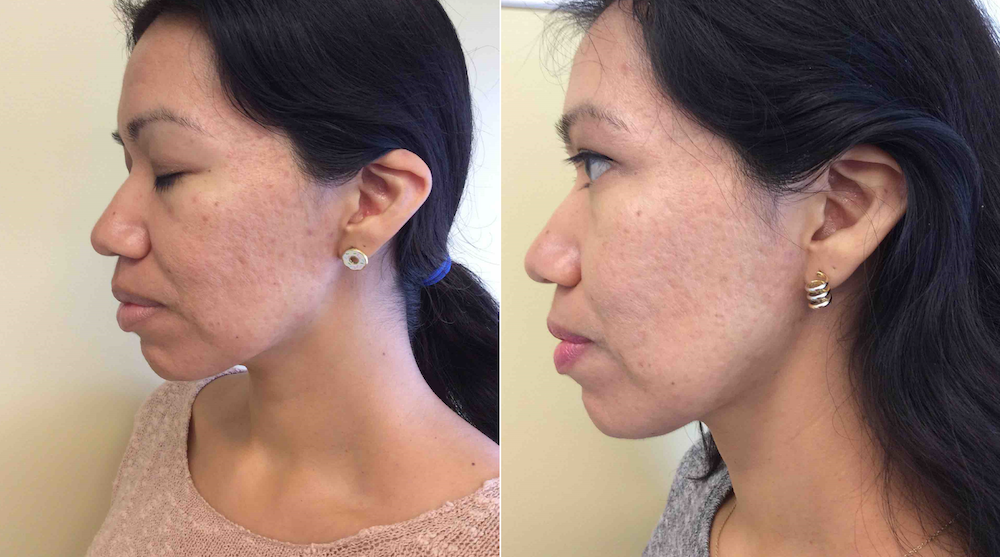 Microneedling with PRP at CosmetiCare to remove acne scars, uneven skin texture and large pores. | livingmividaloca.com | #cosmeticare #beautytreatments #spatreatments
